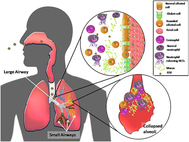 呼吸道融合病毒（Respiratory Syncytial Virus, RSV）