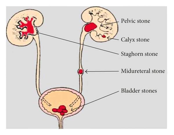 泌尿系統(Urinary System)結石