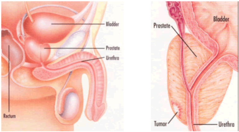 攝護腺癌(Prostate cancer)及 PSA篩檢的利與弊