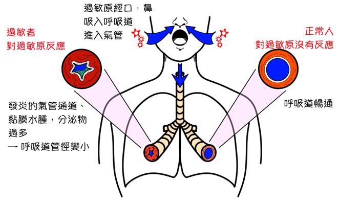 全台200萬人受氣喘困擾 用藥無效當心嚴重型