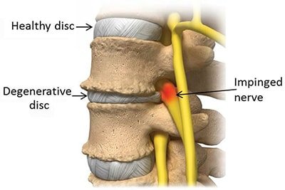 痛痛痛…椎間盤退化症（Degenerative Disc Disease, DDD）