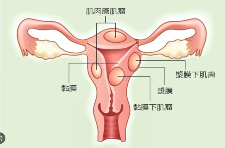 子宮肌瘤大到17公分致子宮破裂 婦人緊急手術保命