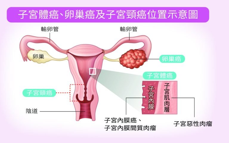 三大女性生殖系統癌症： 子宮頸癌、子宮體癌、卵巢癌