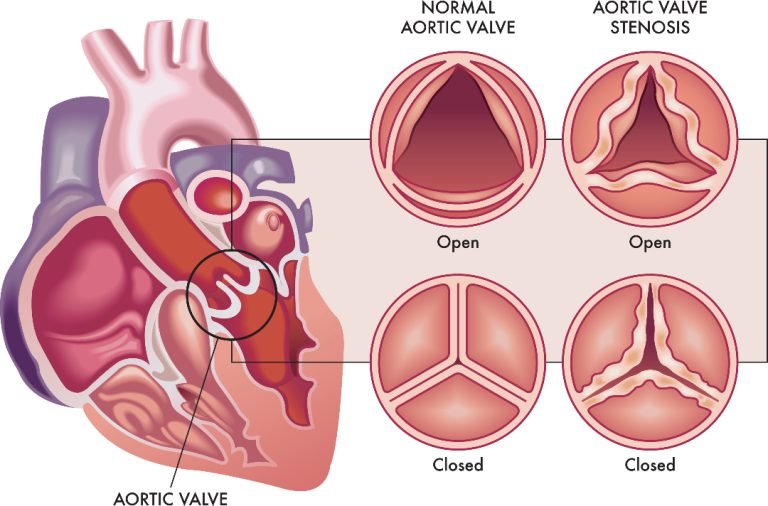 主動脈瓣膜狹窄（Aortic Stenosis, AS）