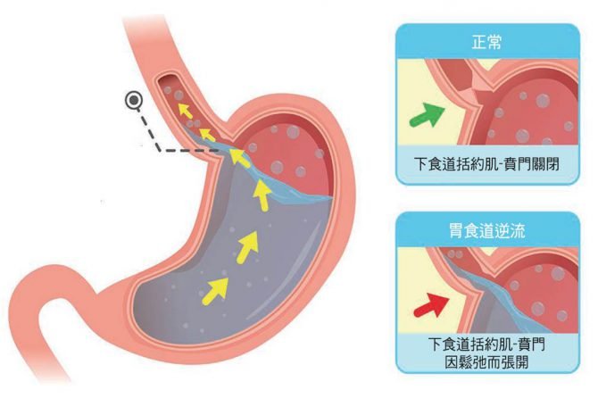 吃飽就躺平 小心胃食道逆流上身