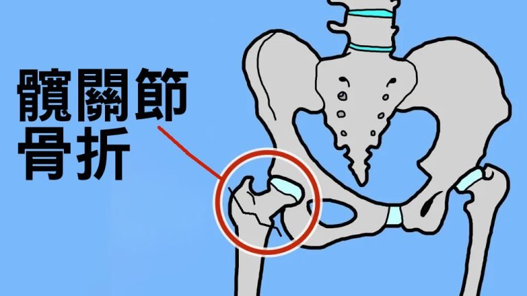 分析報告：老年人骨折後的存活率很低