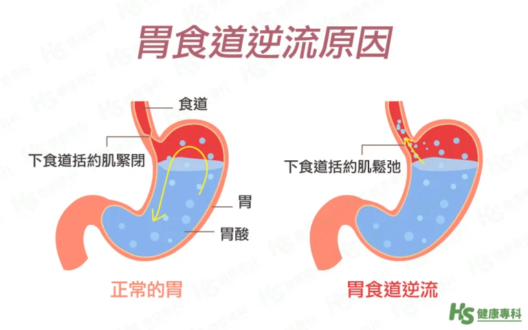 成大醫院：飲食改變生活加快 胃食道逆流發病率近30%