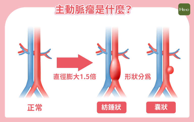 男子腰背痛以為結石復發 竟是腹主動脈瘤作祟