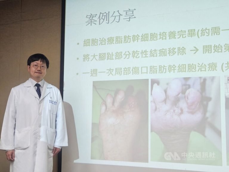 7旬糖尿病婦右腳黑掉 幹細胞立功免截肢